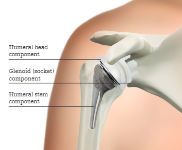 What is shoulder arthorplasty? | Stryker