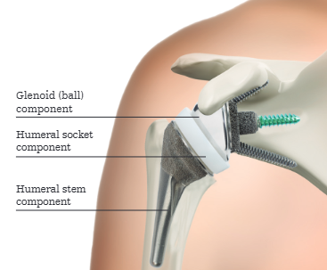 Reverse Shoulder Arthroplasty | Stryker
