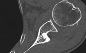 shoulder CT scan