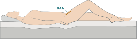 Direct anterior approach person with bent knee